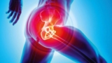 Exercises & Lifetime Precautions After Hip Replacement