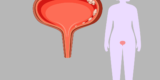 Living with Bladder Cancer – HealthyWomen